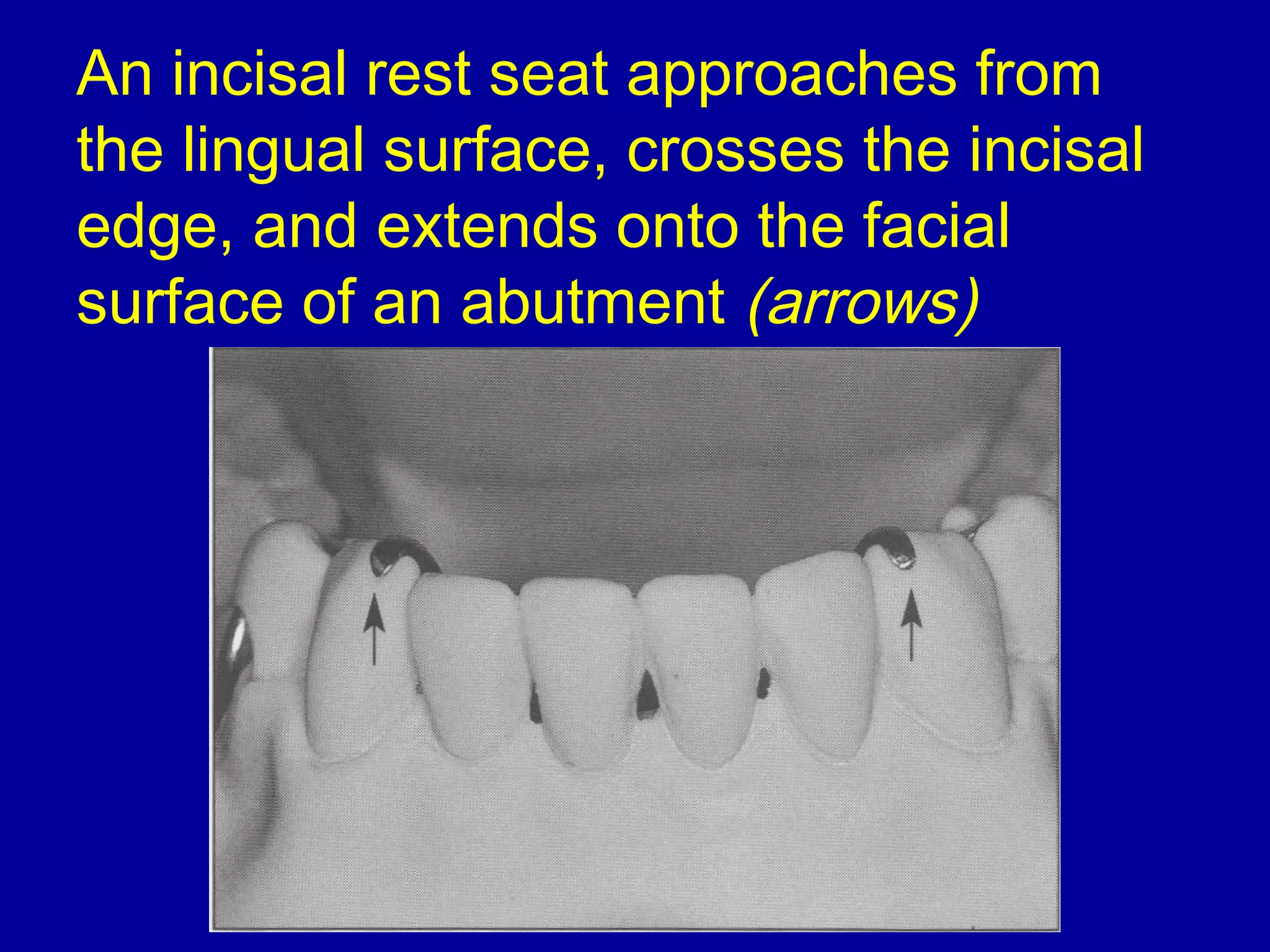 An incisal rest seat approaches from
the lingual surface, crosses the incisal
edge, and extends onto the facial
surface of an abutment (arrows)
 