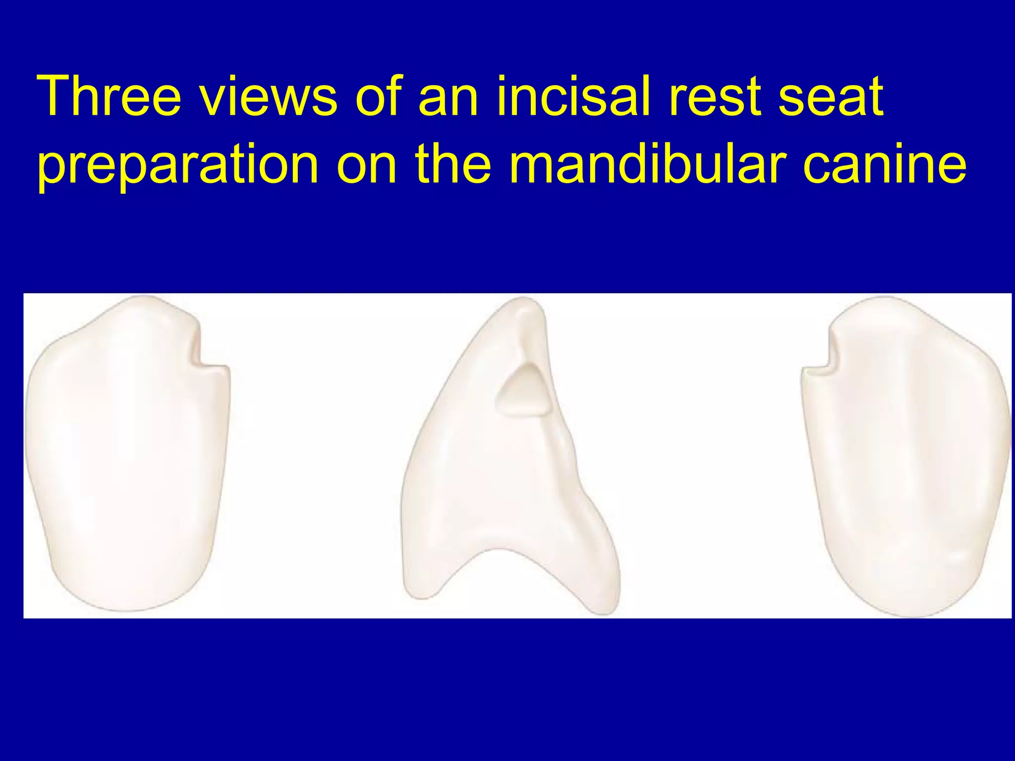 Three views of an incisal rest seat
preparation on the mandibular canine
 