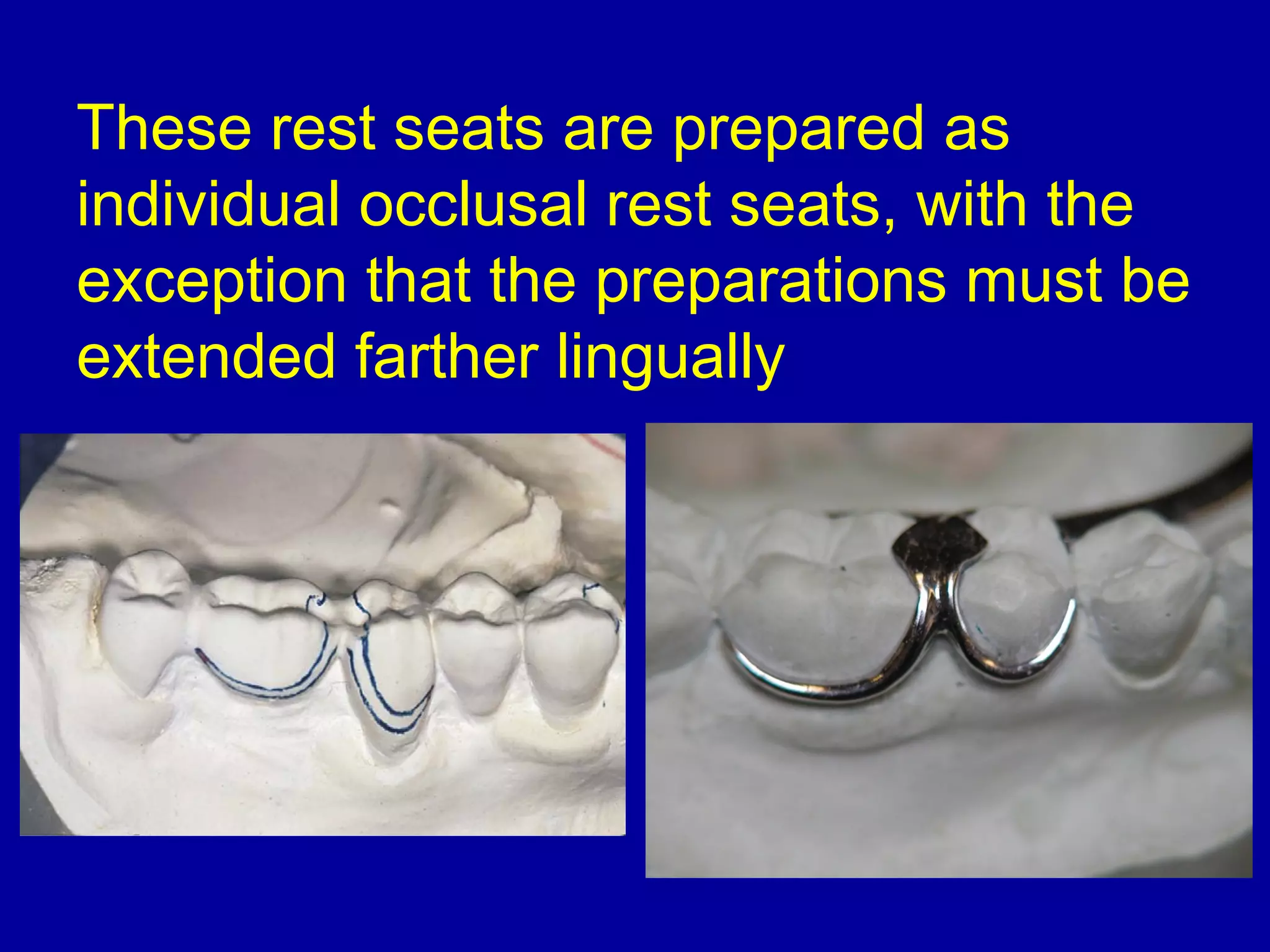 These rest seats are prepared as
individual occlusal rest seats, with the
exception that the preparations must be
extended farther lingually
 