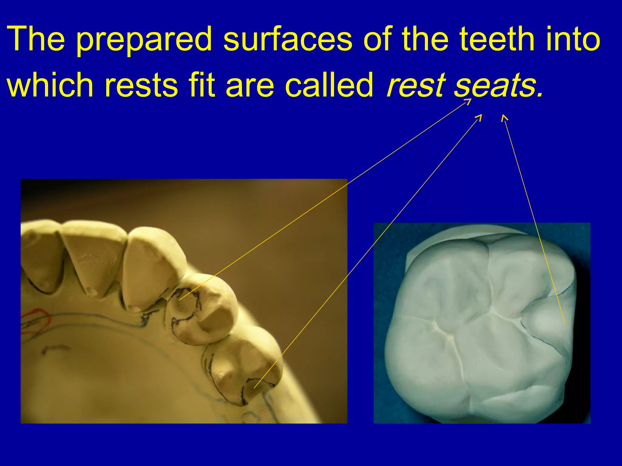 The prepared surfaces of the teeth into
which rests fit are called rest seats.
 
