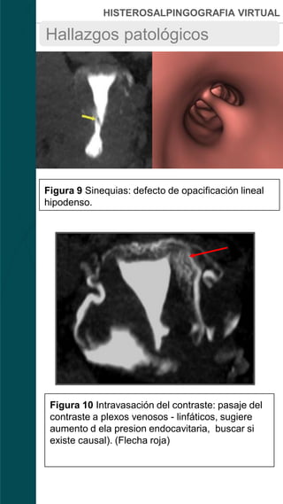 HISTEROSALPINGOGRAFIA VIRTUAL
Figura 9 Sinequias: defecto de opacificación lineal
hipodenso.
Hallazgos patológicos
Figura 10 Intravasación del contraste: pasaje del
contraste a plexos venosos - linfáticos, sugiere
aumento d ela presion endocavitaria, buscar si
existe causal). (Flecha roja)
 