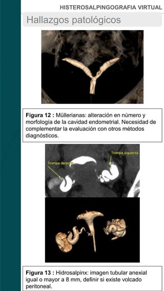 HISTEROSALPINGOGRAFIA VIRTUAL
Hallazgos patológicos
A
C
B
D
Figura 12 : Müllerianas: alteración en número y
morfología de la cavidad endometrial. Necesidad de
complementar la evaluación con otros métodos
diagnósticos.
Figura 13 : Hidrosalpinx: imagen tubular anexial
igual o mayor a 8 mm, definir si existe volcado
peritoneal.
 