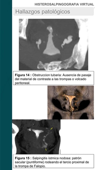 HISTEROSALPINGOGRAFIA VIRTUAL
Figura 14 : Obstruccion tubaria: Ausencia de pasaje
del material de contraste a las trompas o volcado
peritoneal.
Figura 15 : Salpingitis ístmica nodosa: patrón
sacular (puntiforme) rodeando el tercio proximal de
la trompa de Falopio.
Hallazgos patológicos
 