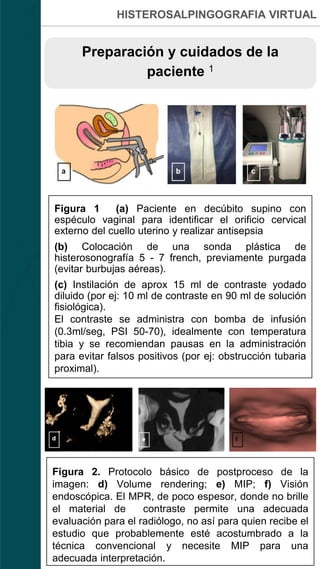 HISTEROSALPINGOGRAFIA VIRTUAL
Preparación y cuidados de la
paciente 1
Figura 1 (a) Paciente en decúbito supino con
espéculo vaginal para identificar el orificio cervical
externo del cuello uterino y realizar antisepsia
(b) Colocación de una sonda plástica de
histerosonografía 5 - 7 french, previamente purgada
(evitar burbujas aéreas).
(c) Instilación de aprox 15 ml de contraste yodado
diluido (por ej: 10 ml de contraste en 90 ml de solución
fisiológica).
El contraste se administra con bomba de infusión
(0.3ml/seg, PSI 50-70), idealmente con temperatura
tibia y se recomiendan pausas en la administración
para evitar falsos positivos (por ej: obstrucción tubaria
proximal).
Figura 2. Protocolo básico de postproceso de la
imagen: d) Volume rendering; e) MIP; f) Visión
endoscópica. El MPR, de poco espesor, donde no brille
el material de contraste permite una adecuada
evaluación para el radiólogo, no así para quien recibe el
estudio que probablemente esté acostumbrado a la
técnica convencional y necesite MIP para una
adecuada interpretación.
 