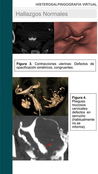 HISTEROSALPINGOGRAFIA VIRTUAL
Hallazgos Normales
Figura 3. Contracciones uterinas: Defectos de
opacificación simétricos, congruentes.
Figura 4.
Pliegues
mucosos
cervicales:
defectos en
serrucho
(habitualmente
no se
informa).
 