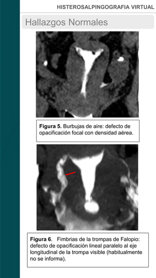 HISTEROSALPINGOGRAFIA VIRTUAL
Figura 5. Burbujas de aire: defecto de
opacificación focal con densidad aérea.
Hallazgos Normales
Figura 6. Fimbrias de la trompas de Falopio:
defecto de opacificación lineal paralelo al eje
longitudinal de la trompa visible (habitualmente
no se informa).
 