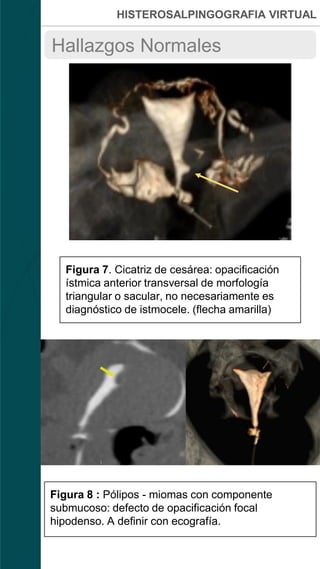 HISTEROSALPINGOGRAFIA VIRTUAL
Hallazgos Normales
Figura 7. Cicatriz de cesárea: opacificación
ístmica anterior transversal de morfología
triangular o sacular, no necesariamente es
diagnóstico de istmocele. (flecha amarilla)
Figura 8 : Pólipos - miomas con componente
submucoso: defecto de opacificación focal
hipodenso. A definir con ecografía.
 