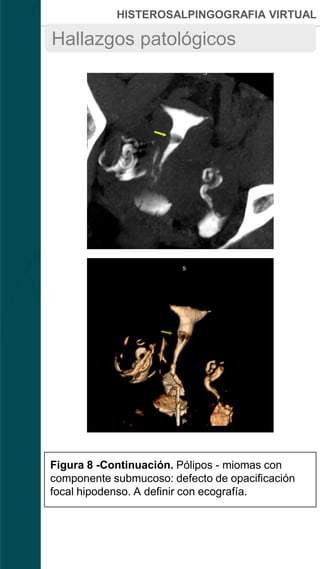 HISTEROSALPINGOGRAFIA VIRTUAL
Hallazgos patológicos
A
C
B
D
Figura 8 -Continuación. Pólipos - miomas con
componente submucoso: defecto de opacificación
focal hipodenso. A definir con ecografía.
 