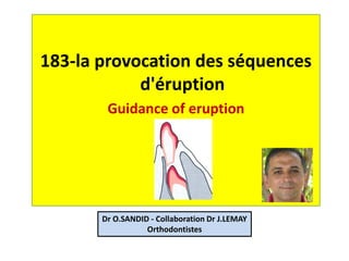 183-la provocation des séquences
d'éruption
Guidance of eruption
Dr O.SANDID - Collaboration Dr J.LEMAY
Orthodontistes
 