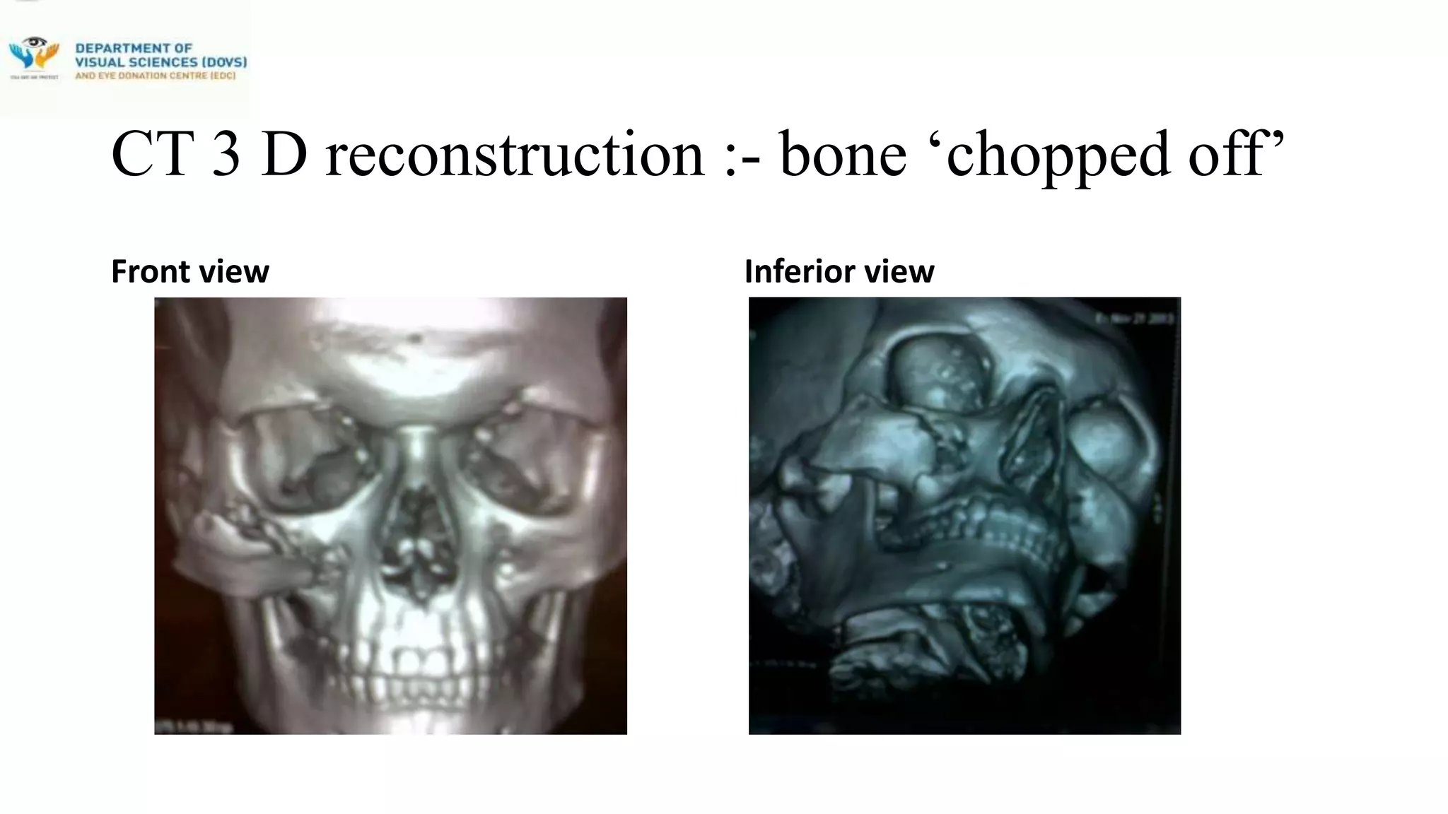 A Case Of Chopper Assault Injury Managed With Three Stage Surgical ...