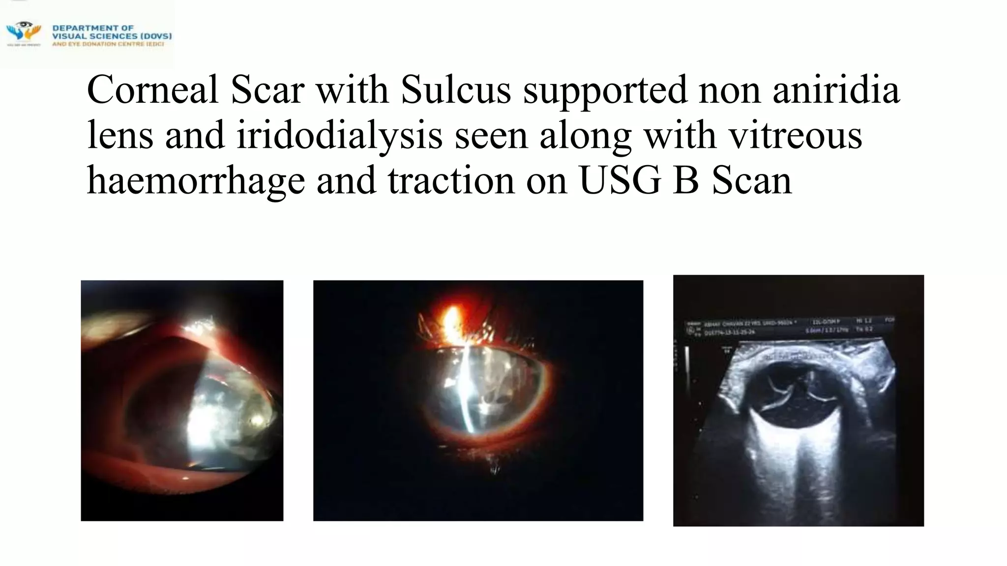 A Case Of Chopper Assault Injury Managed With Three Stage Surgical ...