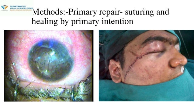 three stages of skin graft healing