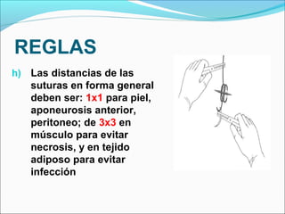 REGLAS
h) Las distancias de las
suturas en forma general
deben ser: 1x1 para piel,
aponeurosis anterior,
peritoneo; de 3x3 en
músculo para evitar
necrosis, y en tejido
adiposo para evitar
infección
 