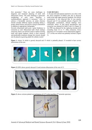 Shaik I et al. Dilaceration of Maxillary Second Premolar Tooth.
128
Journal of Advanced Medical and Dental Sciences Research |Vol. 8|Issue 6| June 2020
first premolars.3
There are some challenges in
diagnosis and treatment planning of teeth with
dilacerated crowns. The main challenge is particular
morphology of such cases; therefore, a
multidisciplinary approach is necessary.4
Also, to
achieve a favourable outcome, an astute clinician
should consider different aspects including taking a
proper dental history and precise clinical examination
in addition to appropriate radiography.5
Severely dilacerated teeth pose a great hindrance to
extraction as well. Dilacerated teeth which undergo
extraction, there is an obvious need to replace missing
teeth with dental implants, which is more common
and predictable treatment strategy but concern should
also be placed on growing adults for esthetic results.6
CASE DETAILS
A 26-year-old male patient reported to our clinic with
the chief complaint of diffuse pain due to decayed
tooth in the right upper posterior quadrant. On clinical
examination, it was observed that 16 was grossly
decayed and 15 was palatally placed. (Figure1) On
radiographic examination, clinical findings were
confirmed, where 16 had apical periodontitis and
extraction was planned for both15 and 16. (Figure 2)
An FPD was planned for the replacing missing teeth
extending from 14 to 17. After extraction, Gross
specimen of 15 revealed a severe dilaceration (approx.
117°) of the root which was palatally inclined. (Figure
3)
Figure 1- shows 16 which is grossly decayed and 15 which is palatally placed. 15 revealed to have severe
dilaceration of the root.
Figure 2- IOPA shows grossly decayed 16 and extreme dilaceration of the root of 15.
Figure 3- shows extreme palatal root inclination of 117° in the maxillary 2nd
premolar specimen.
 