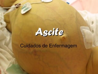 AsciteAscite
Cuidados de Enfermagem
 