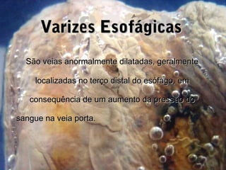 São veias anormalmente dilatadas, geralmenteSão veias anormalmente dilatadas, geralmente
localizadas no terço distal do esófago, emlocalizadas no terço distal do esófago, em
consequência de um aumento da pressão doconsequência de um aumento da pressão do
sangue na veia porta.sangue na veia porta.
Varizes EsofágicasVarizes Esofágicas
 