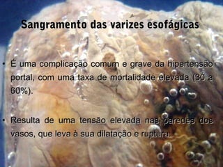 Sangramento das varizes esofágicasSangramento das varizes esofágicas
• É uma complicação comum e grave da hipertensãoÉ uma complicação comum e grave da hipertensão
portal, com uma taxa de mortalidade elevada (30 aportal, com uma taxa de mortalidade elevada (30 a
60%).60%).
• Resulta de uma tensão elevada nas paredes dosResulta de uma tensão elevada nas paredes dos
vasos, que leva à sua dilatação e ruptura.vasos, que leva à sua dilatação e ruptura.
 