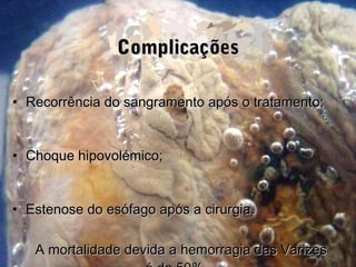 ComplicaçõesComplicações
• Recorrência do sangramento após o tratamento;Recorrência do sangramento após o tratamento;
• Choque hipovolémico;Choque hipovolémico;
• Estenose do esófago após a cirurgia.Estenose do esófago após a cirurgia.
A mortalidade devida a hemorragia das VarizesA mortalidade devida a hemorragia das Varizes
 