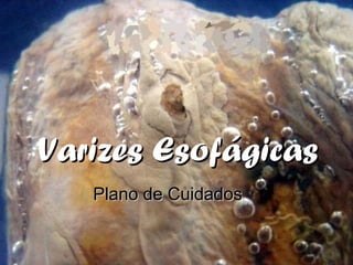 Plano de CuidadosPlano de Cuidados
Varizes EsofágicasVarizes Esofágicas
 