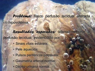 Problema:Problema: Risco perfusão tecidual alteradaRisco perfusão tecidual alterada
r/c hipovolémia.r/c hipovolémia.
Resultados esperados:Resultados esperados: Manter/melhorar aManter/melhorar a
perfusão tecidual, evidenciado por:perfusão tecidual, evidenciado por:
• Sinais vitais estáveis;Sinais vitais estáveis;
• Pele aquecida;Pele aquecida;
• Pulsos periféricos palpáveis;Pulsos periféricos palpáveis;
• Gasimetria arterial normal;Gasimetria arterial normal;
• Débito urinário normal.Débito urinário normal.
 