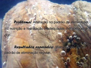 Problema:Problema: Alteração no padrão de eliminaçãoAlteração no padrão de eliminação
r/c nutrição e hidratação inadequadas, hemorragia er/c nutrição e hidratação inadequadas, hemorragia e
dor.dor.
Resultados esperados:Resultados esperados: Manutenção de umManutenção de um
padrão de eliminação regular.padrão de eliminação regular.
 