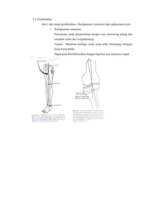 F.2 Pembedahan
      Ada 2 tipe terapi pembedahan : Realignment osteotomi dan replacement joint
             1. Realignment osteotomi
                 Permukaan sendi direposisikan dengan cara memotong tulang dan
                 merubah sudut dari weightbearing.
                 Tujuan : Membuat karilago sendi yang sehat menopang sebagian
                 besar berat tubuh.
                 Dapat pula dikombinasikan dengan ligamen atau meniscus repair
 