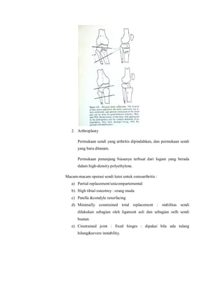 2. Arthroplasty

       Permukaan sendi yang arthritis dipindahkan, dan permukaan sendi
       yang baru ditanam.

       Permukaan penunjang biasanya terbuat dari logam yang berada
       dalam high-density polyethylene.

Macam-macam operasi sendi lutut untuk osteoarthritis :
   a) Partial replacement/unicompartemental
   b) High tibial osteotmy : orang muda
   c) Patella &condyle resurfacing
   d) Minimally constrained total replacement : stabilitas sendi
       dilakukan sebagian oleh ligament asli dan sebagian oelh sendi
       buatan.
   e) Cinstrained joint : fixed hinges : dipakai bila ada tulang
       hilang&severe instability.
 
