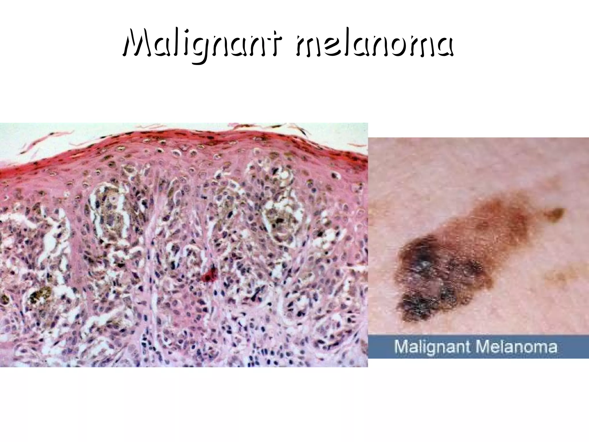 Malignant melanoma 