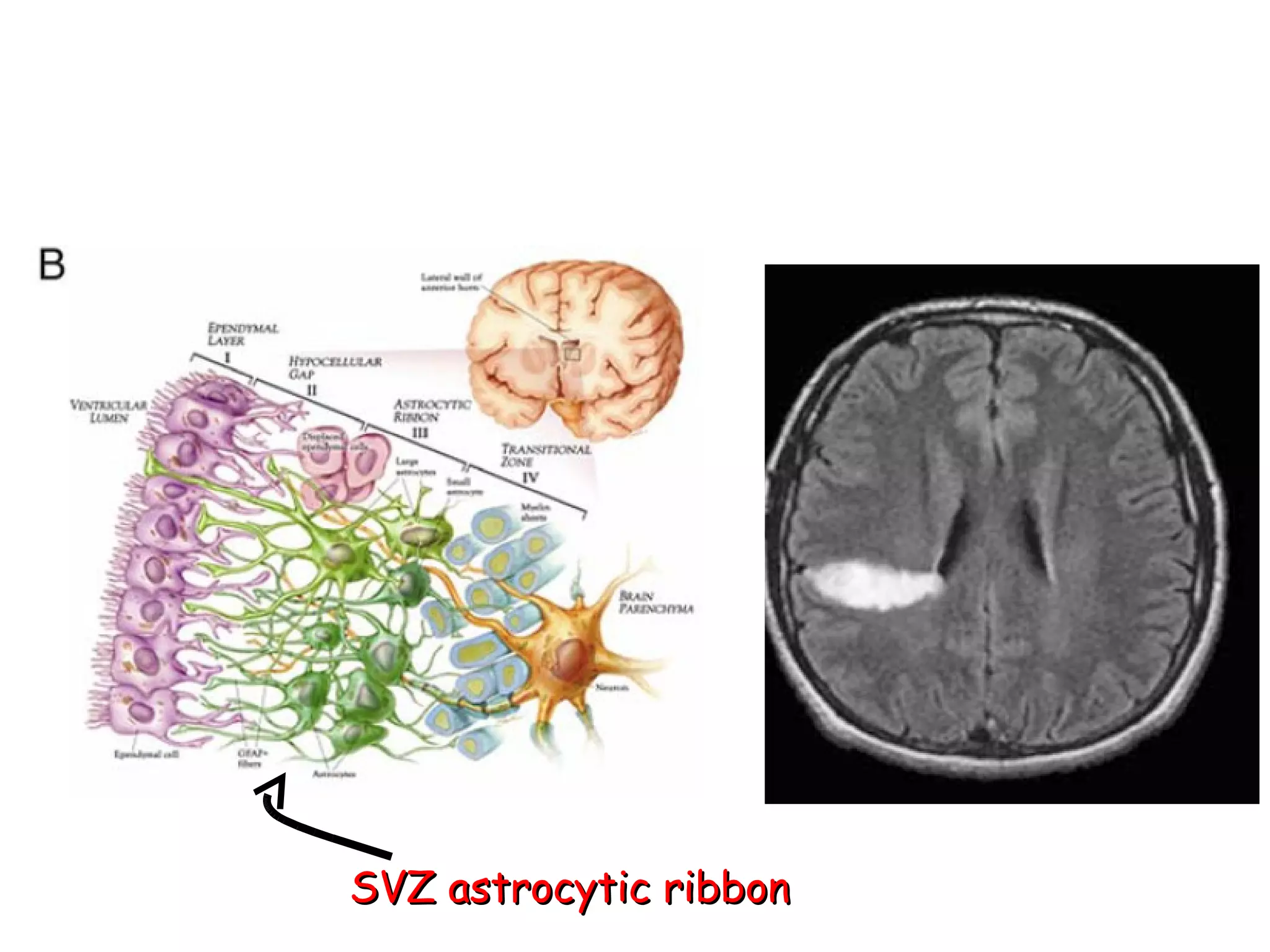 SVZ astrocytic ribbon 