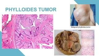 Phylloid Pattern 18) Benign and Malignant Diseases of Breast .pdf