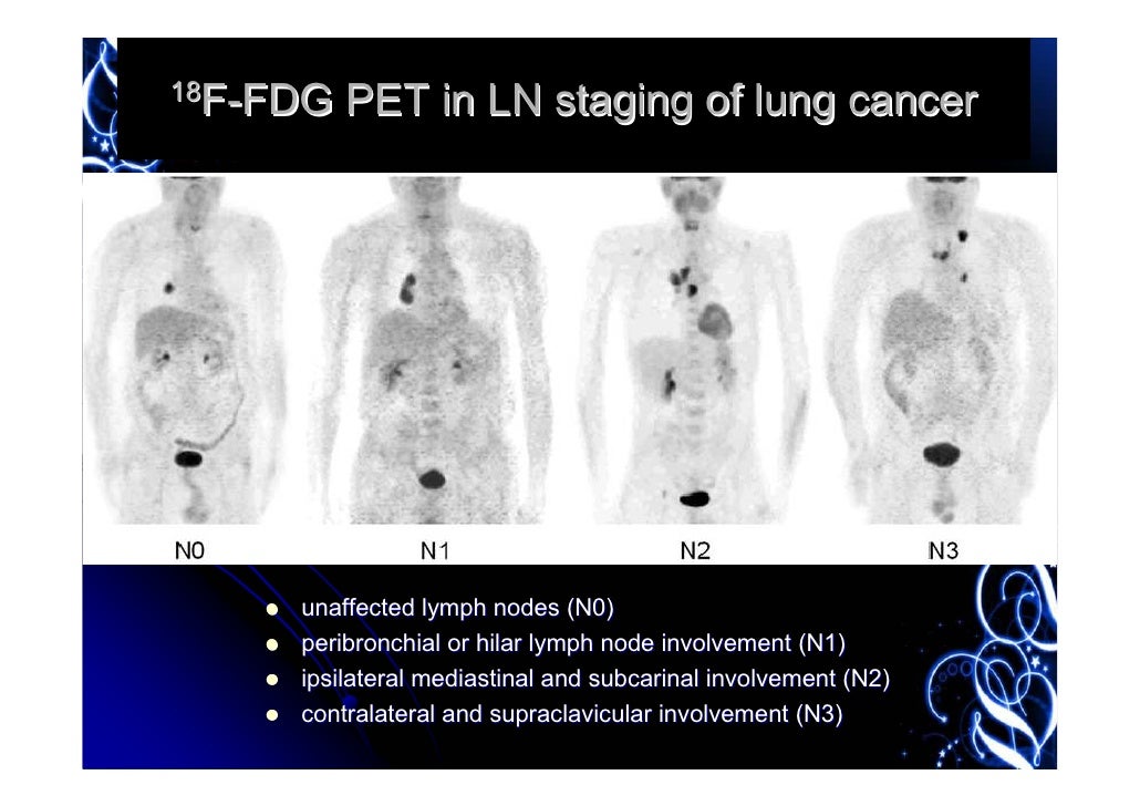 18F FDG PET For Mediastinal Staging