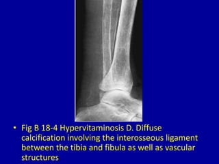 18 generalized calcification or ossification in muscles and | PPTX ...