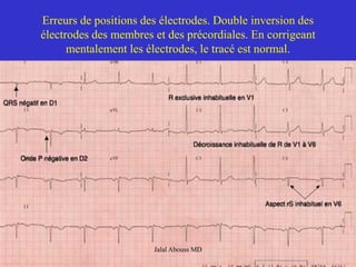 Erreurs de positions des électrodes. Double inversion des
électrodes des membres et des précordiales. En corrigeant
mentalement les électrodes, le tracé est normal.
Jalal Abouss MD
 