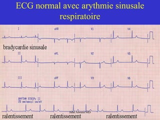 ECG normal avec arythmie sinusale
respiratoire
Jalal Abouss MD
 