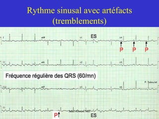 Rythme sinusal avec artéfacts
(tremblements)
Jalal Abouss MD
 