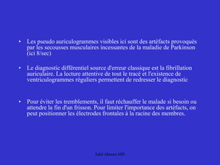 • Les pseudo auriculogrammes visibles ici sont des artéfacts provoqués
par les secousses musculaires incessantes de la maladie de Parkinson
(ici 8/sec)
• Le diagnostic différentiel source d'erreur classique est la fibrillation
auriculaire. La lecture attentive de tout le tracé et l'existence de
ventriculogrammes réguliers permettent de redresser le diagnostic
• Pour éviter les tremblements, il faut réchauffer le malade si besoin ou
attendre la fin d'un frisson. Pour limiter l'importance des artéfacts, on
peut positionner les électrodes frontales à la racine des membres.
Jalal Abouss MD
 