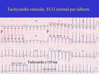 Tachycardie sinusale. ECG normal par ailleurs
Jalal Abouss MD
 