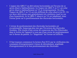 • L'aspect des QRS-T en dérivations horizontales est l'inverse de ce
qu'on observe habituellement. Ici l'aspect du QRS-T en V1 est celui
qu'on observe habituellement en V6 et réciproquement. De plus,
l'aspect du QRS-T en V6 est très différent de celui observé en D1. Or
ces deux dérivations sont généralement très similaires (sauf en cas
d'axe hyperdroit). Ici le QRS-T observé en V6 est inhabituel, donc
l'erreur porte sur le positionnement des électrodes horizontales.
• L'erreur de positionnement des électrodes horizontales est
exceptionnelle, beaucoup plus rare que l'inversion des électrodes
frontales. Elle résulte d'une erreur de connexion des fils d'électrodes
dans le boitier de l'appareil et non pas d'une erreur de positionnement
sur le thorax du patient. Le "diagnostic" de l'erreur est difficile.
• Il faut toujours commencer la lecture d'un ECG par la vérification des
constantes d'enregistrement (vitesse de déroulement, amplitude
d'enregistrement) et le bon positionnement des électrodes
Jalal Abouss MD
 
