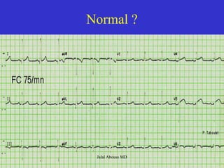 18 Heart EKG.pdf