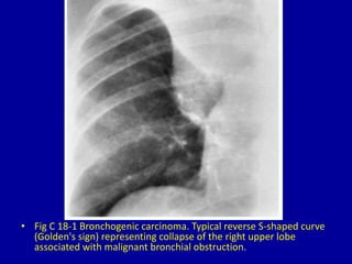 • Fig C 18-1 Bronchogenic carcinoma. Typical reverse S-shaped curve
(Golden's sign) representing collapse of the right upper lobe
associated with malignant bronchial obstruction.
 