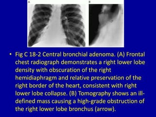 • Fig C 18-2 Central bronchial adenoma. (A) Frontal
chest radiograph demonstrates a right lower lobe
density with obscuration of the right
hemidiaphragm and relative preservation of the
right border of the heart, consistent with right
lower lobe collapse. (B) Tomography shows an ill-
defined mass causing a high-grade obstruction of
the right lower lobe bronchus (arrow).
 