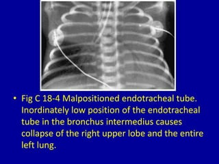 • Fig C 18-4 Malpositioned endotracheal tube.
Inordinately low position of the endotracheal
tube in the bronchus intermedius causes
collapse of the right upper lobe and the entire
left lung.
 