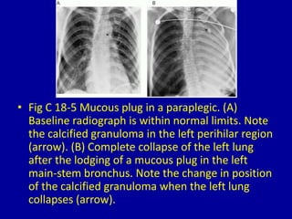 • Fig C 18-5 Mucous plug in a paraplegic. (A)
Baseline radiograph is within normal limits. Note
the calcified granuloma in the left perihilar region
(arrow). (B) Complete collapse of the left lung
after the lodging of a mucous plug in the left
main-stem bronchus. Note the change in position
of the calcified granuloma when the left lung
collapses (arrow).
 