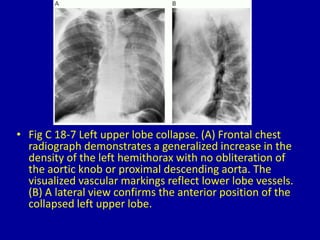 • Fig C 18-7 Left upper lobe collapse. (A) Frontal chest
radiograph demonstrates a generalized increase in the
density of the left hemithorax with no obliteration of
the aortic knob or proximal descending aorta. The
visualized vascular markings reflect lower lobe vessels.
(B) A lateral view confirms the anterior position of the
collapsed left upper lobe.
 