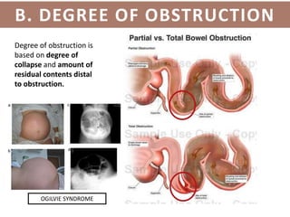 Obstructive Defacation Management of intestinal obstruction | PPTX