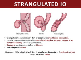 Management of intestinal obstruction | PPTX