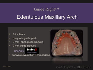 Guide Right™
               Edentulous Maxillary Arch


        6 implants
            magnetic guide post
            3 mm open guide sleeves
            2 mm guide sleeves
                        Invivo5
             GALAXIS   Anatomage
        software evaluation ▪ comparison



HOO 2.2013
 