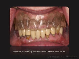 Duplicate, trim and try the denture in to be sure it still fits etc.
 