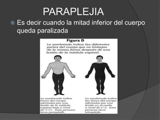PARAPLEJIA
 Es decir cuando la mitad inferior del cuerpo
queda paralizada
 