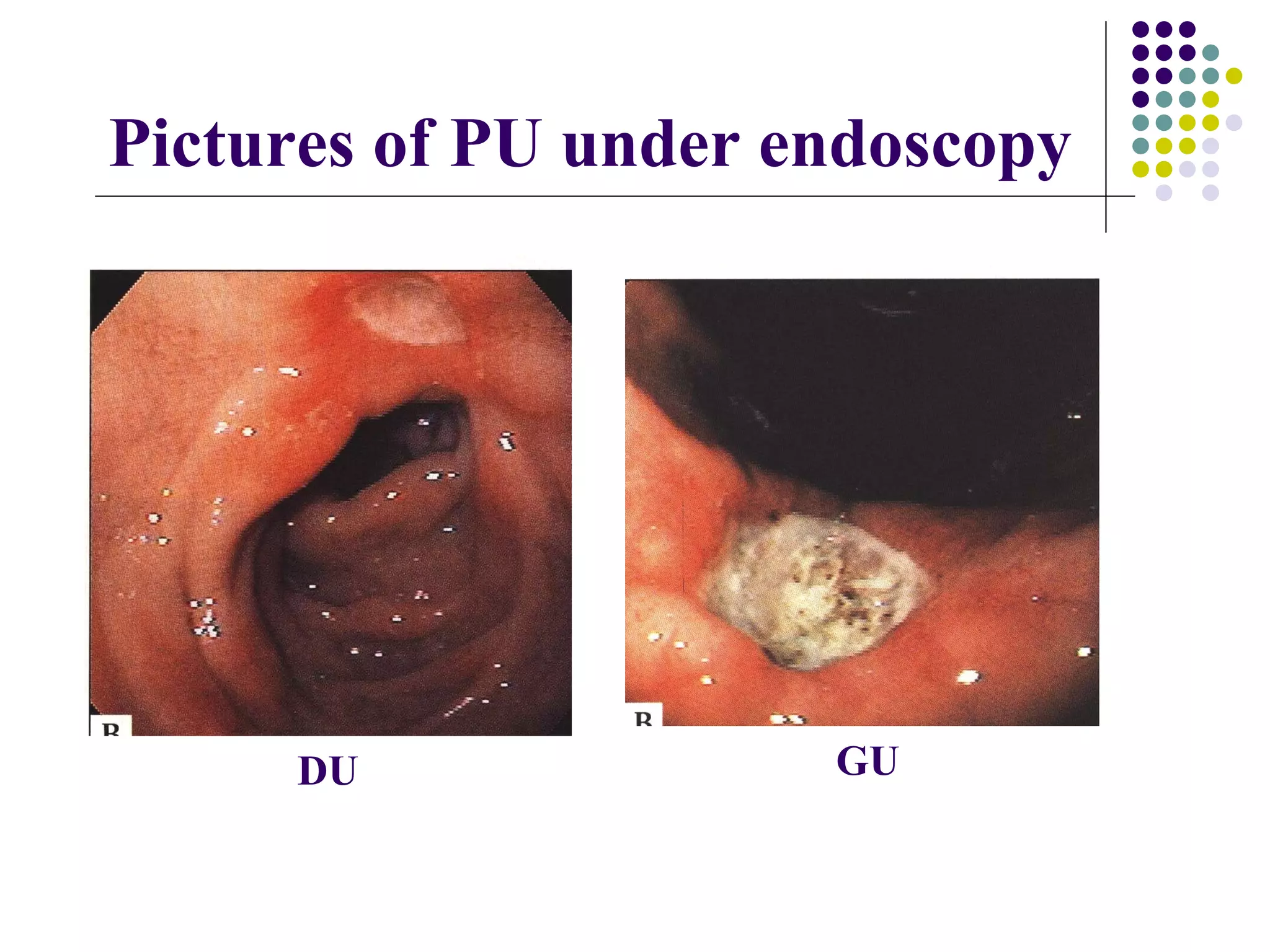 Pictures of PU under endoscopy DU GU 
